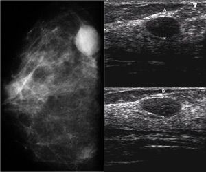 Mamografia e Ultrassom